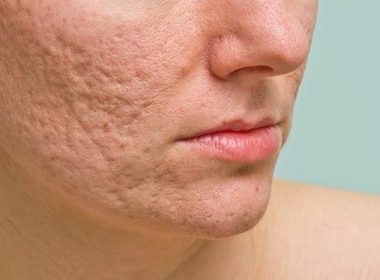 Come eliminare le cicatrici da acne